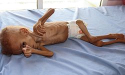 "الجحيم على الأرض".. اليمن يُواجه أكبر مجاعة في التاريخ الحديث